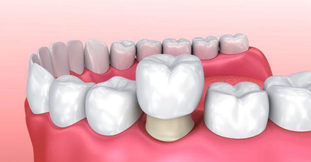 Dental Crowns Bridges Treatment Delhi India