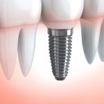Dental Implants Clinic Delhi Dwarka India