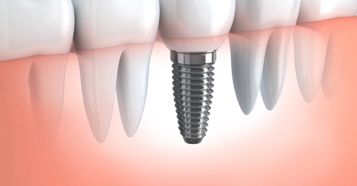 Dental Implants Clinic Delhi Dwarka India