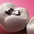 Dental Tooth Fillings Cost Delhi India
