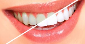 Teeth Whitening Clinic Treatment Cost Delhi
